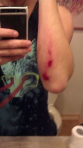 Chris arm injury dec 2013