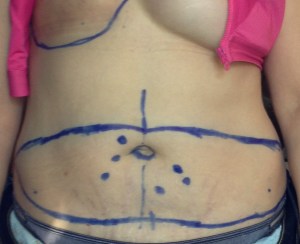 Marked up belly