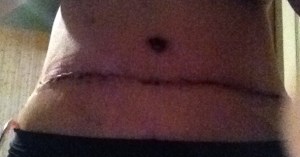 abdomen 2 weeks later