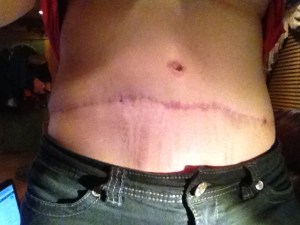 abdomen scar